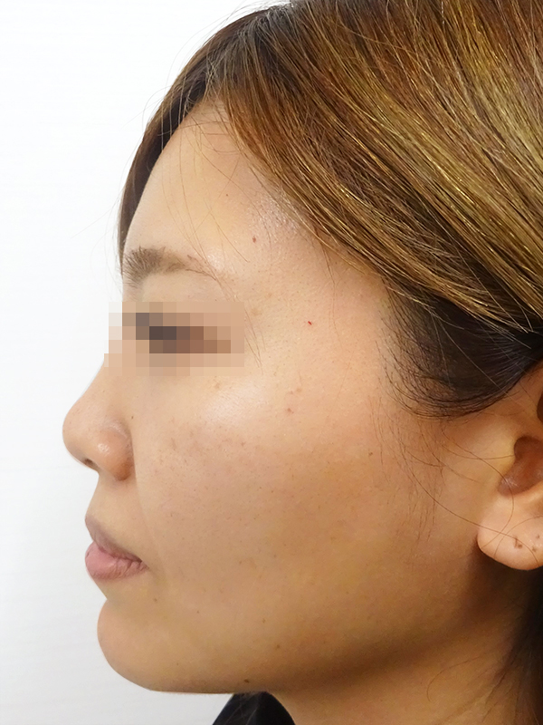 鼻プロテーゼ（隆鼻術）の症例写真01