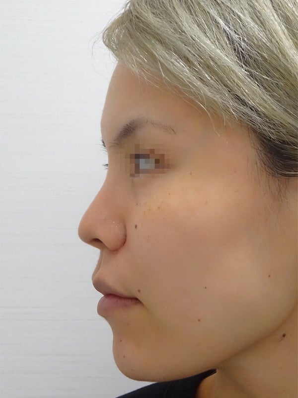 鼻プロテーゼ（隆鼻術）の症例写真04”