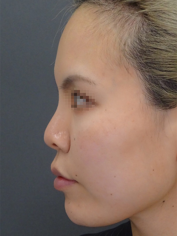 鼻プロテーゼ（隆鼻術）の症例写真03