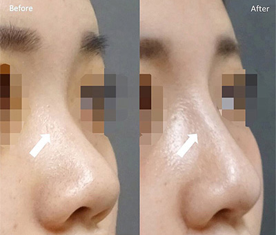 鼻プロテーゼ（隆鼻術） | 鼻の整形 | 美容整形はTCB東京中央美容外科