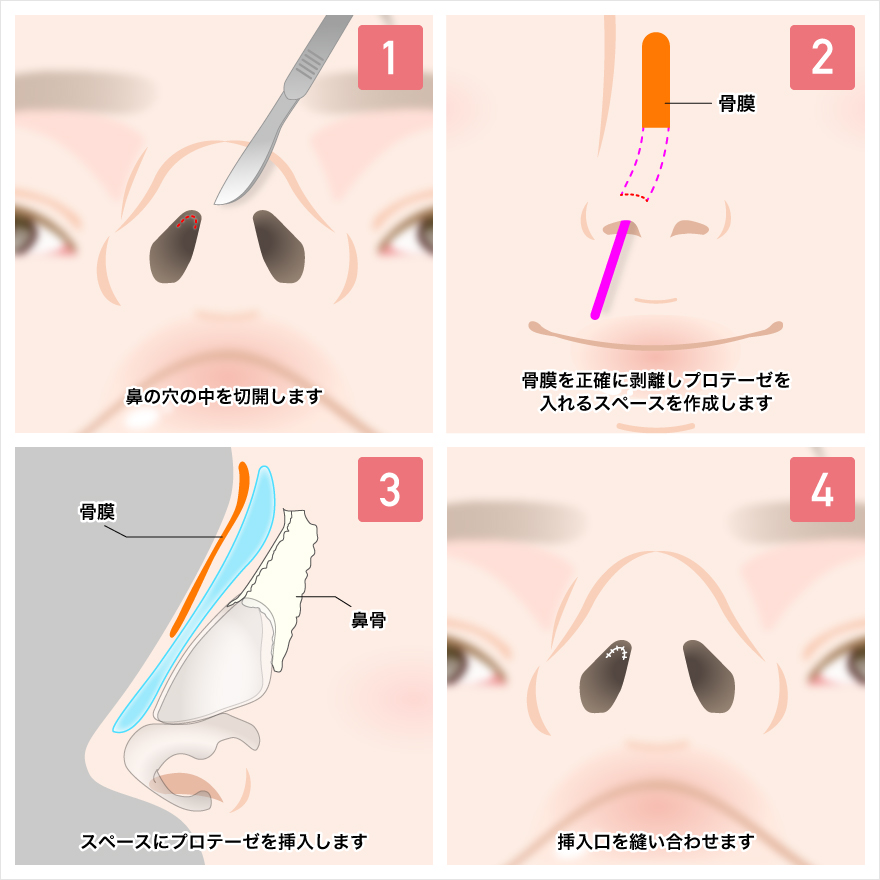 鼻プロテーゼ（隆鼻術）の手術方法について