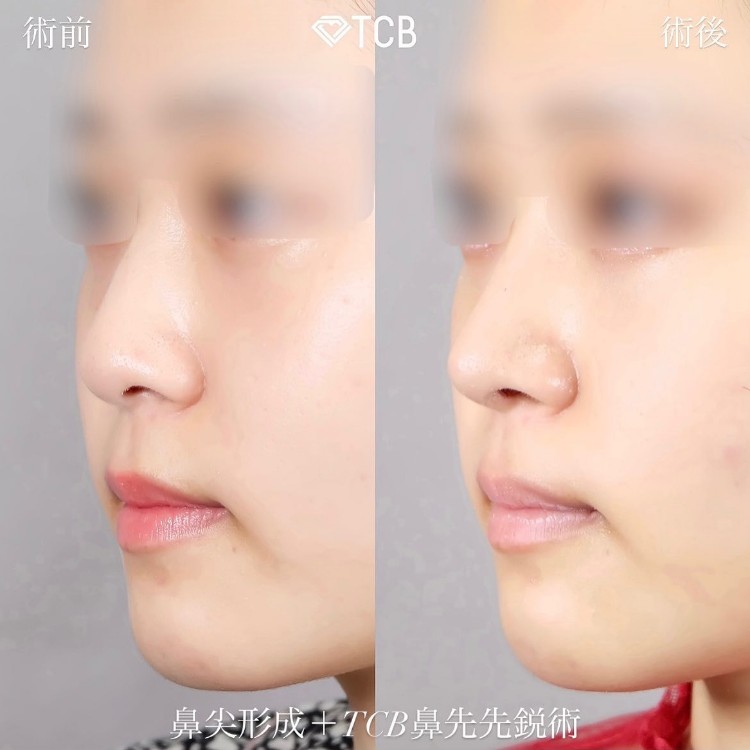 鼻尖形成の症例写真
