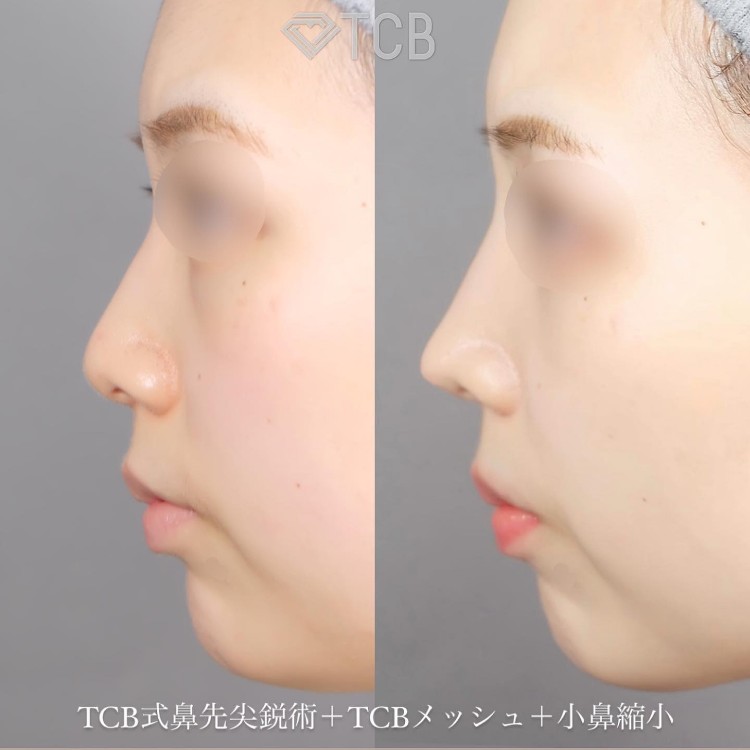 TCB式鼻先尖鋭術（団子鼻解消）の症例写真