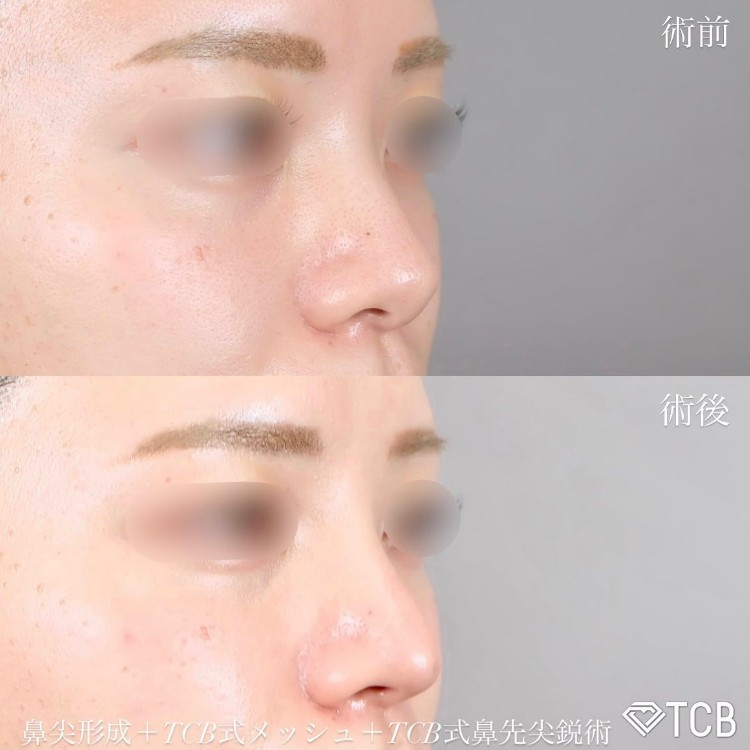 TCB式鼻先尖鋭術（団子鼻解消）の症例写真