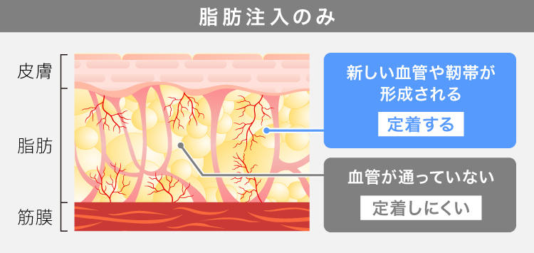 脂肪注入とリジェネラを併用した時の違い 脂肪注入のみ