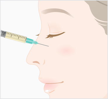 リジェネラ（RIGENERA）の治療方法4