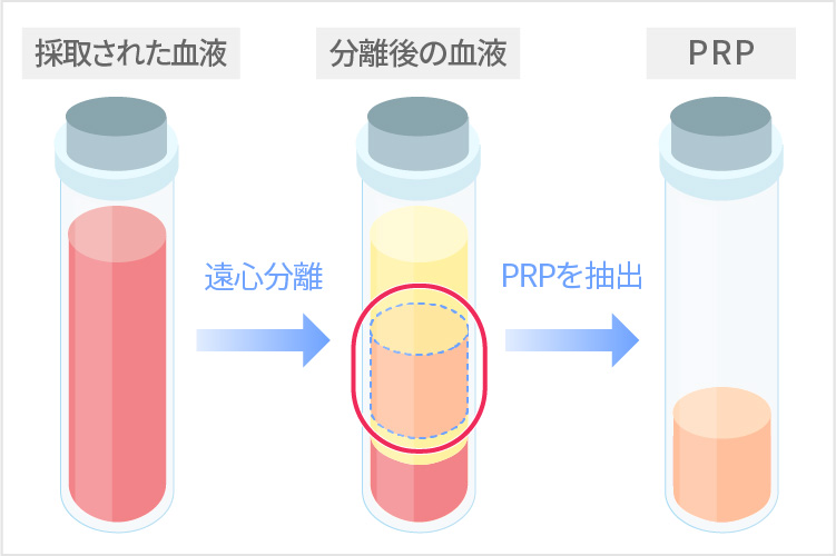 PRPを抽出する過程のイラスト