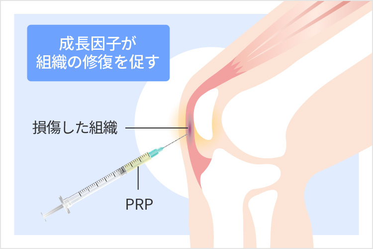 関節にPRPを注入するイラスト