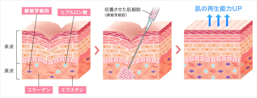 線維芽細胞は老化にした肌に効果的