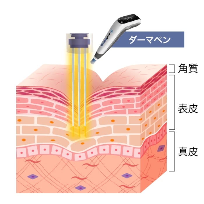 ダーマペン4 | スキンケア（ニキビ跡・毛穴開き） | 美容整形はTCB東京中央美容外科