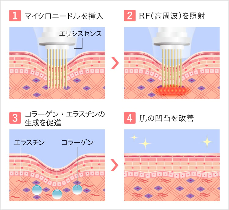 エリシスセンスの効果