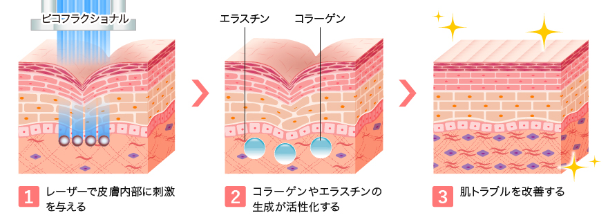 ピコフラクショナルの効果