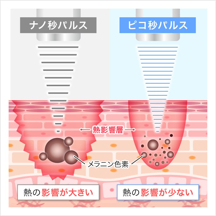 ピコレーザー（ピコスポット）の特徴