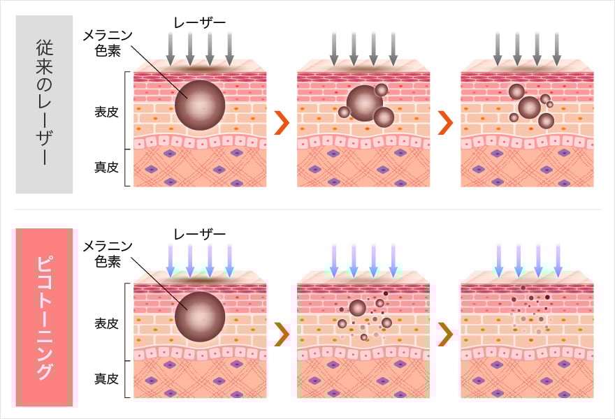 ピコトーニングでメラニン色素を粉砕する仕組み