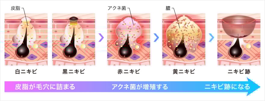 ニキビの種類