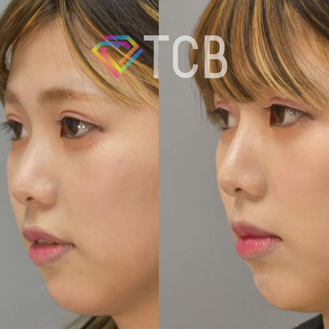 美容整形 二重整形はtcb東京中央美容外科