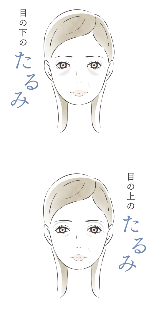 目周りアイリフト Hifuハイフ 話題の 切らないリフトアップ治療 で目周りがスッキリ軽く 美容整形なら東京中央美容外科 Tcb公式