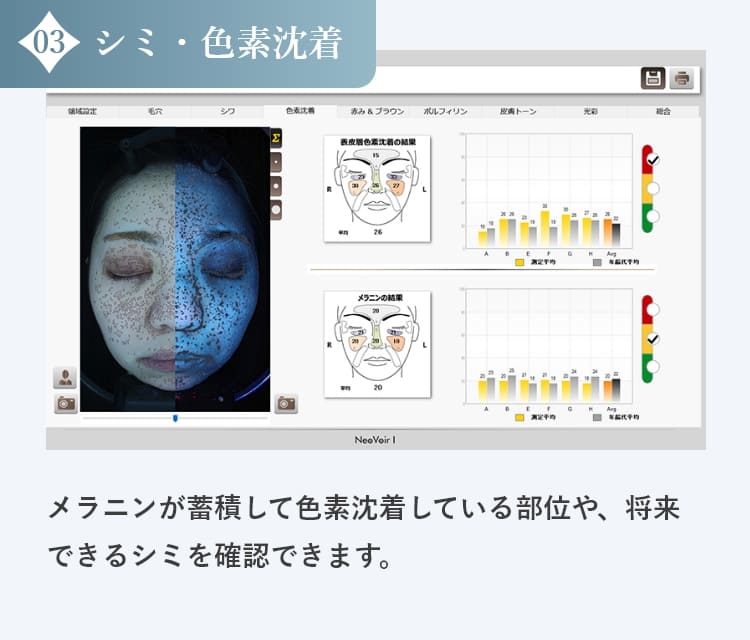 シミ・色素沈着の診断結果