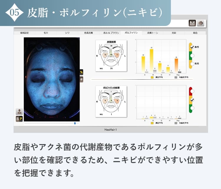 皮脂・ポルフィリン（ニキビ）の診断結果