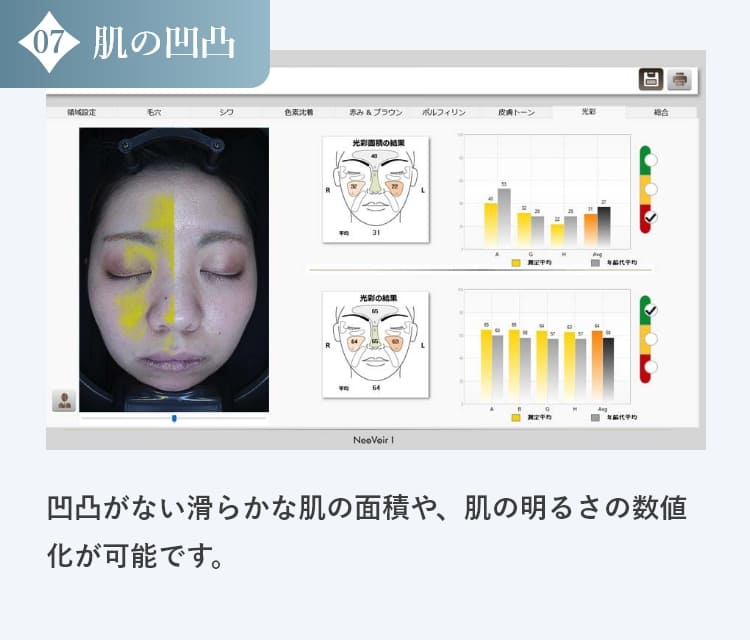 肌の凹凸の診断結果