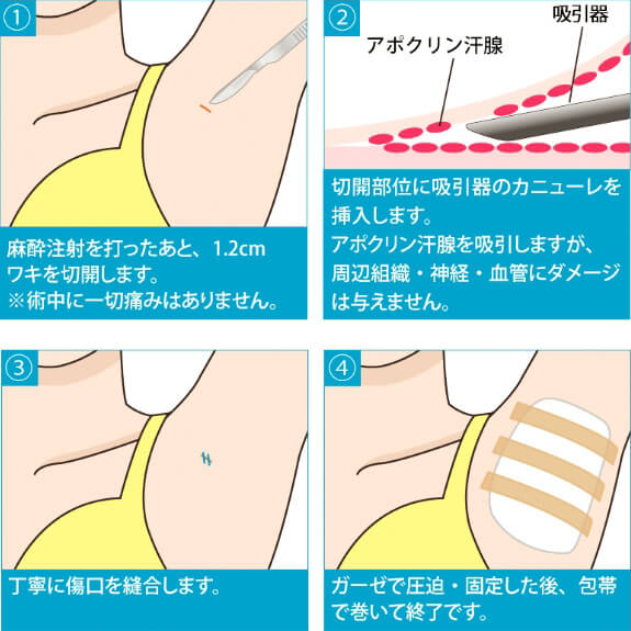 中程度のわきがにおすすめ 吸引シェービング法