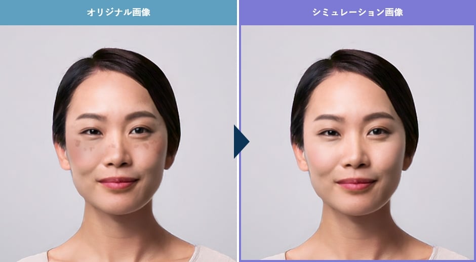 シミ取りのAIシミュレーションイメージ