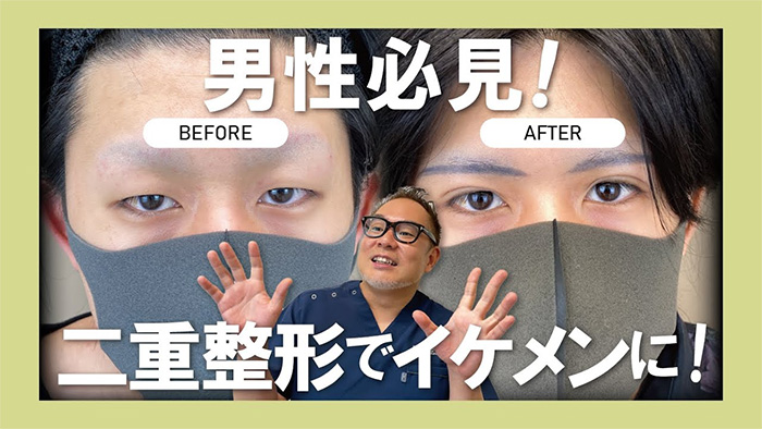 メンズの二重整形におけるビフォーアフターを医師が解説する動画サムネイル