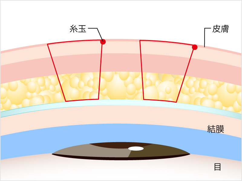 二重 ふたえ 整形 埋没法 腫れない二重 ふたえ 埋没法 1dayクイックアイ 美容整形なら東京中央美容外科 Tcb公式