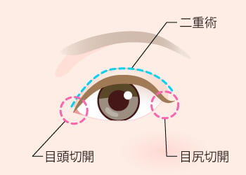 目頭切開は二重と合わせることで欧米 ハーフ美女のような平行二重効果を発揮 Tcbの目頭切開はダウンタイムが少なく値段も抑えてあります 美容整形なら東京中央美容外科 Tcb公式