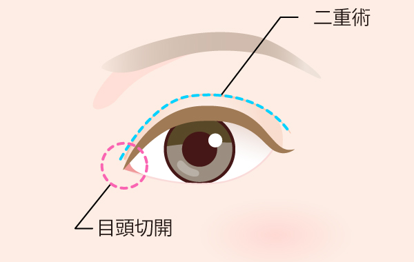 目頭切開は二重と合わせることで欧米 ハーフ美女のような平行二重効果を発揮 Tcbの目頭切開はダウンタイムが少なく値段も抑えてあります 美容整形なら東京中央美容外科 Tcb公式