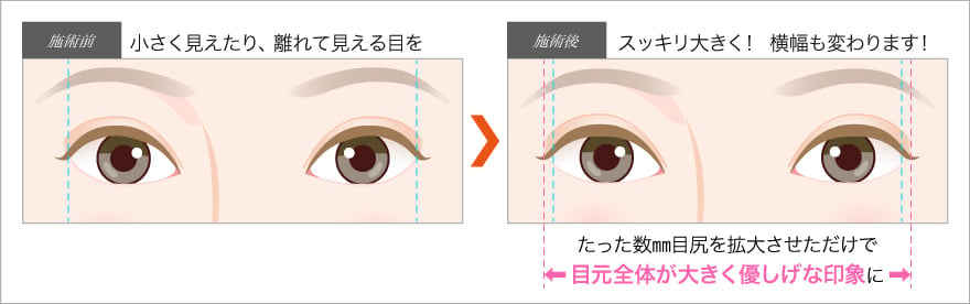 目尻切開で小さく見えたり離れて見える目をすっきり大きく！横幅も変わる効果が！