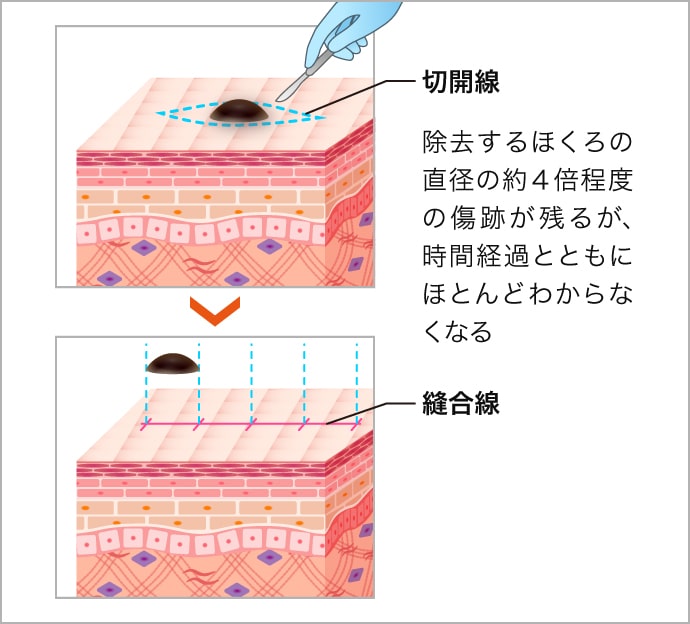 ほくろ除去 いぼ除去 跡が残らないレーザー治療や再発しづらい切開法 美容整形なら東京中央美容外科 Tcb公式