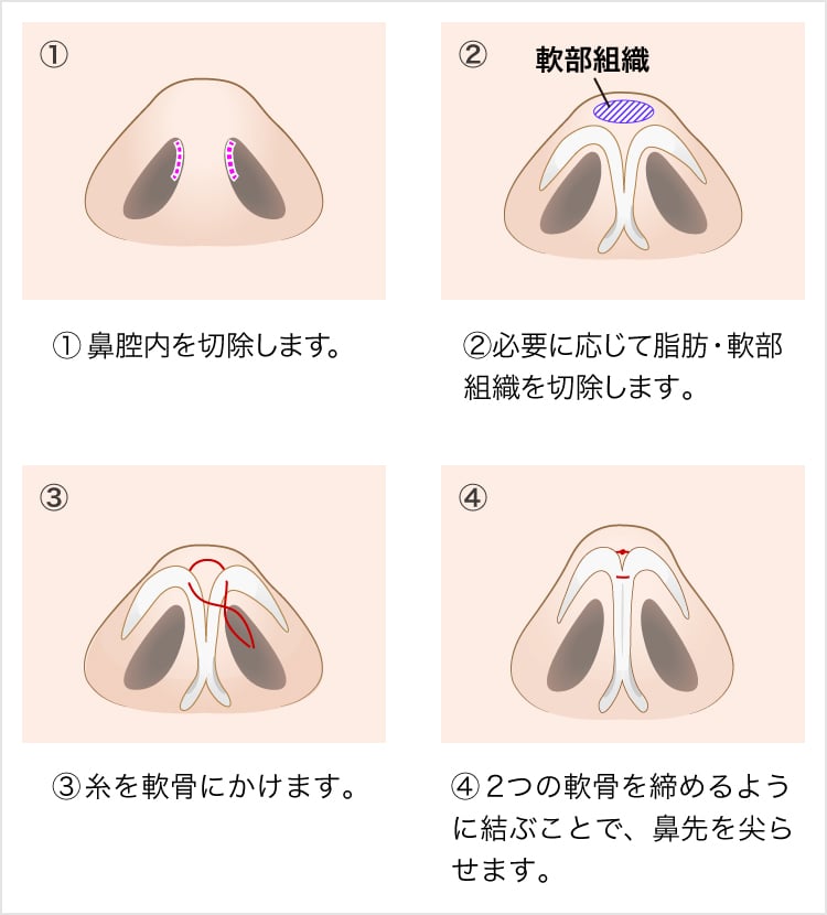 鼻尖形成 美容整形なら東京中央美容外科 Tcb公式