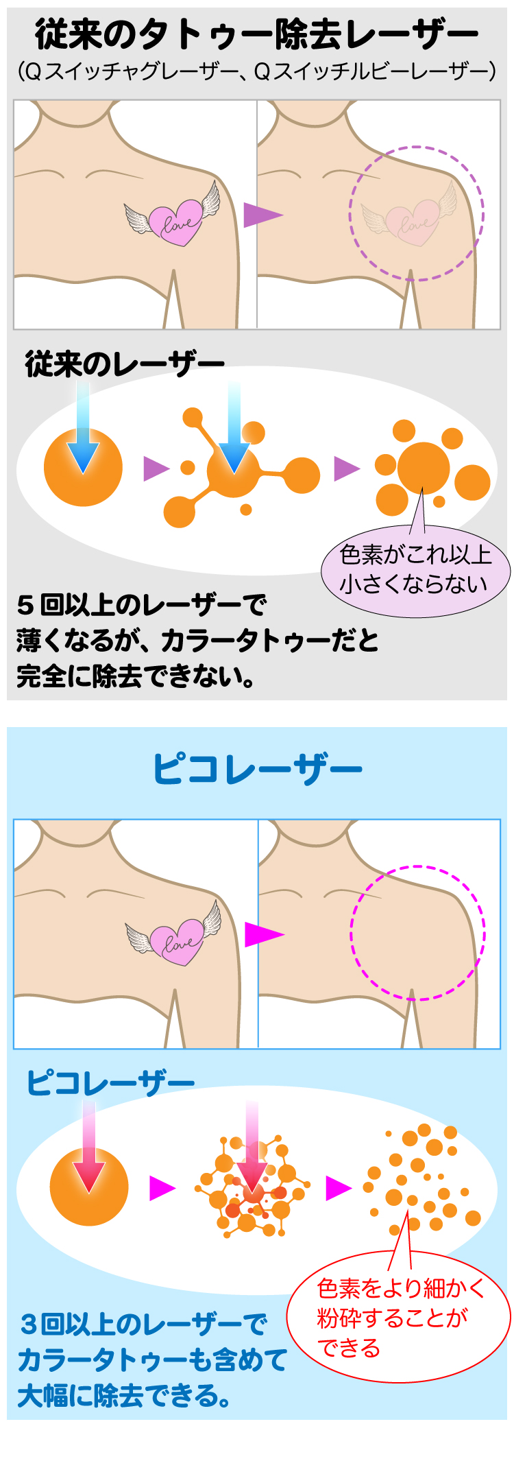 ピコレーザーだとカラータトゥーも除去できます