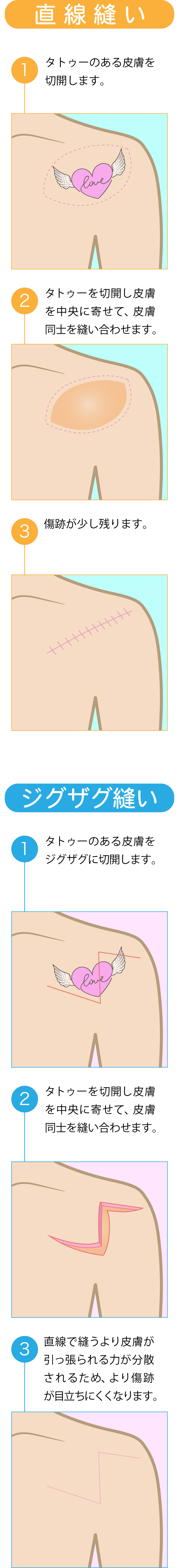 タトゥーを完全になくしたい方は、切開法によるタトゥー除去が適しています