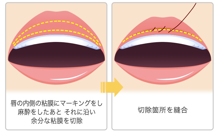 スマートリップ たらこ唇整形 美容整形なら東京中央美容外科 Tcb公式