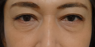 切開法による目の下のたるみ取り（下眼瞼除皺術）症例写真01_before