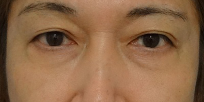 切開法による目の下のたるみ取り（下眼瞼除皺術）症例写真01_after