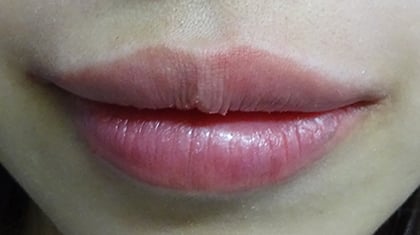 唇のヒアルロン酸注射の症例写真06