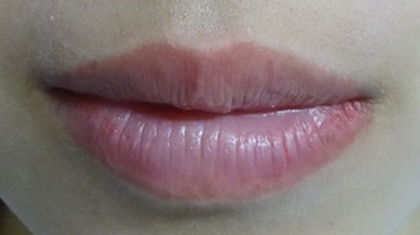 唇のヒアルロン酸注射の症例写真05