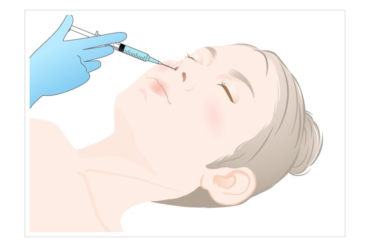 鼻腔内滴下法です。ボトックスを鼻腔内に滴下します。注射ではありませんので、痛みはありません。