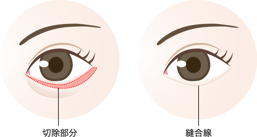 下眼瞼除皺術の手術方法：切開部/縫合線