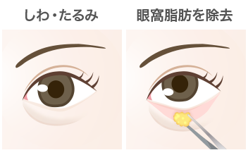 切開法の目の下のたるみ取り（下眼瞼除皺術）手順：眼窩脂肪を除去