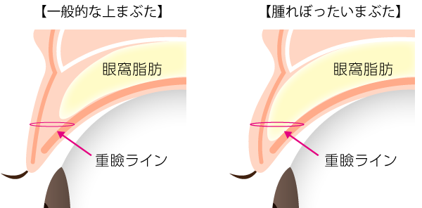 上まぶたの脂肪取り 眼窩脂肪を減らして腫れぼったさを解消 美容整形なら東京中央美容外科 Tcb公式