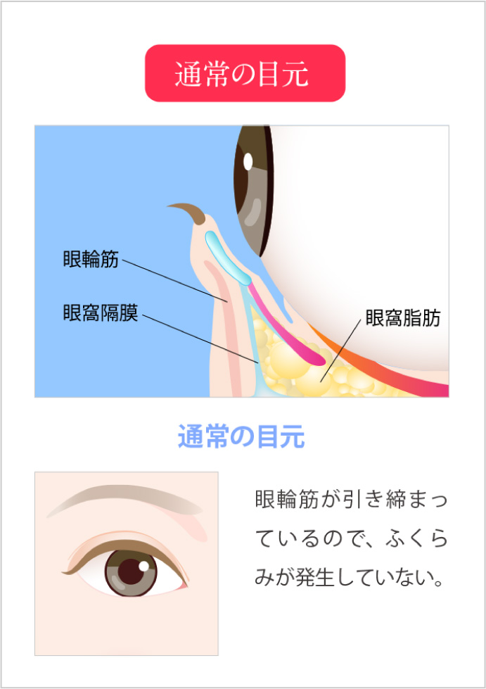 正常な目元と目の下に膨らみがある目元の比較と特徴。通常の目元/眼輪筋が引き締まっているので、ふくらみが発生していない。