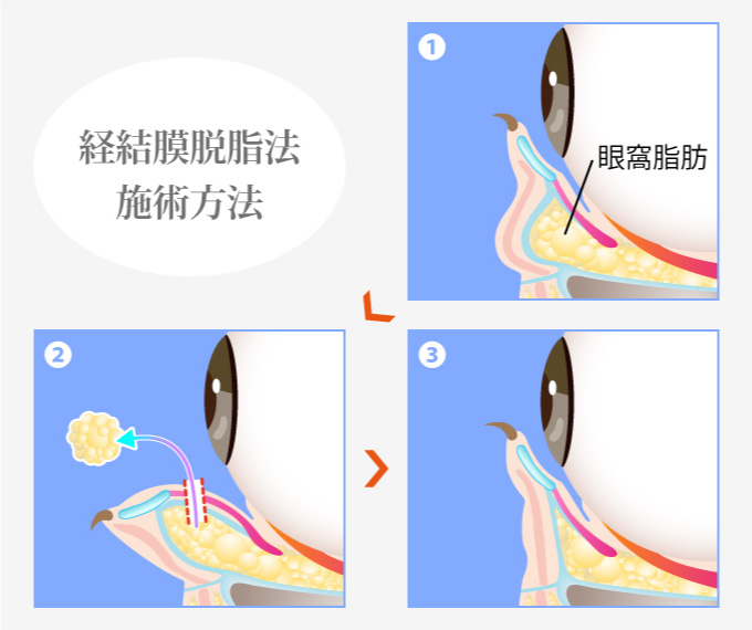 目の下のクマ取り・たるみ取り 経結膜脱脂法の施術方法と流れ