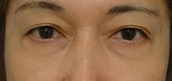 目の下のふくらみの脂肪を取り除く、たるんだ余分な皮膚を切る。