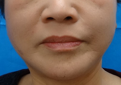 TCB式小顔美肌再生-症例写真-ビフォーアフター