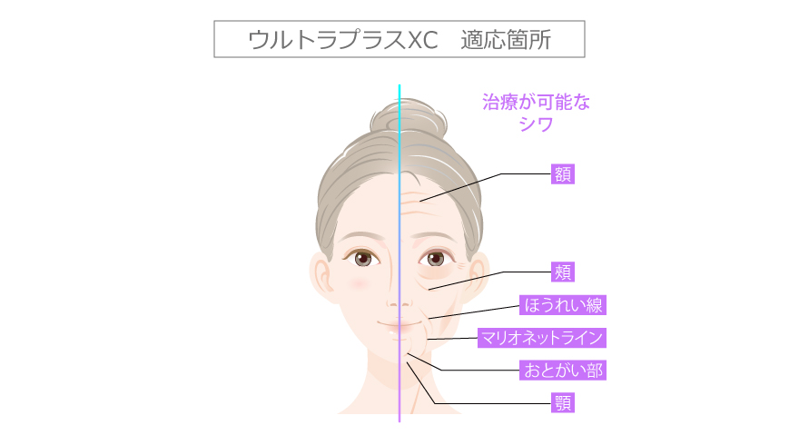 新世代型ヒアルロン酸ジュビダームビスタ | 美容整形はTCB東京中央美容外科