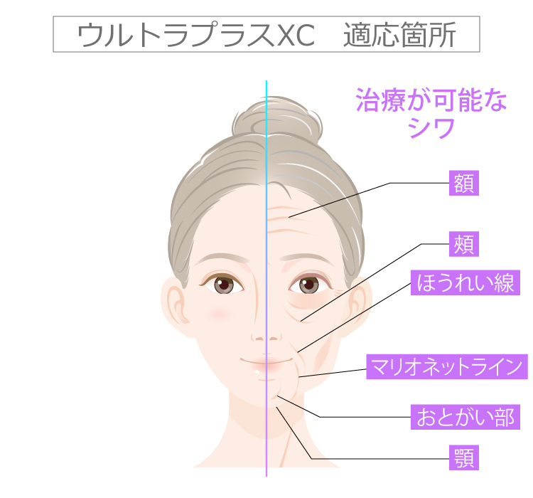 新世代型ヒアルロン酸ジュビダームビスタ | 美容整形はTCB東京中央美容外科